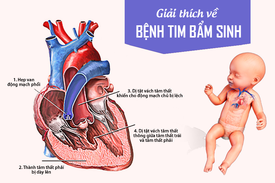 Nghị lực phi thường của cậu bé mắc hội chứng Down và tim bẩm sinh